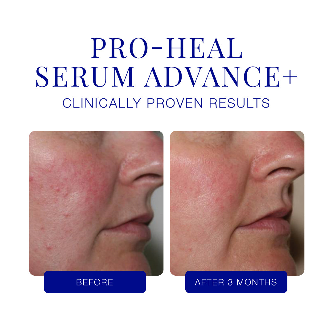 IS Clinical Pro-Heal Serum Advance - Kraftfuldt antioxidant-serum med L-ascorbinsyre (vitamin C), oliven blade og zink, der reducerer inflammation, rødme og acne. Ideel til sensitiv, rosacea og problemhud. Vises i signatur orange flaske.